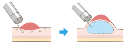EMR1